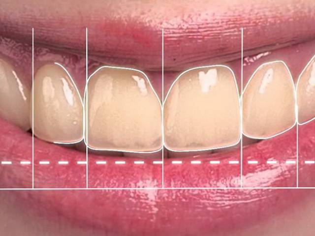 Smile Design & Zahnkronen Side / Antalya Türkei